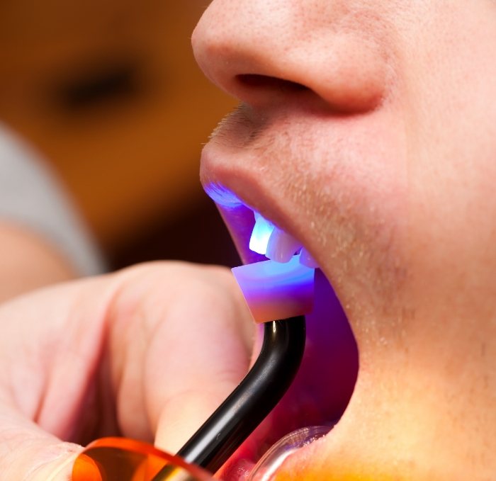 Close up of man receiving cosmetic dental bonding in dental office