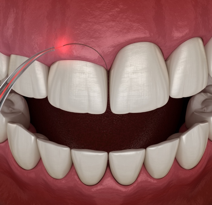 Animated dental laser removing excess gum tissue with crown lengthening in Brandon