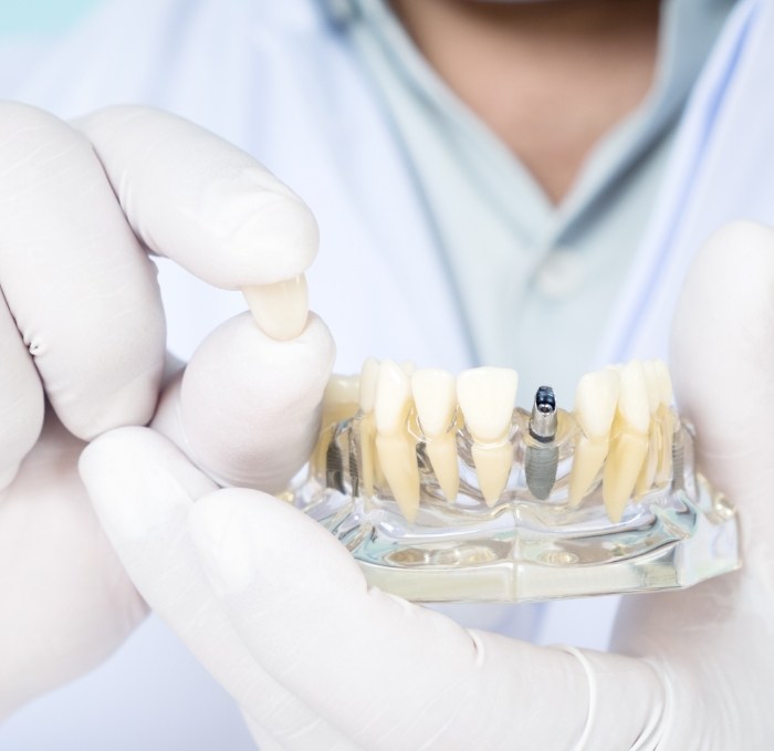 Person holding dental crown in one hand and dental implant model in the other