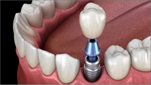 Animated dental implant with dental crown