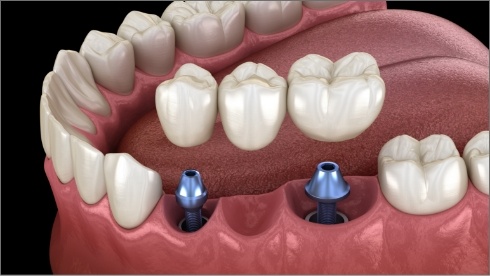 Animated dental bridge being placed over two dental implants