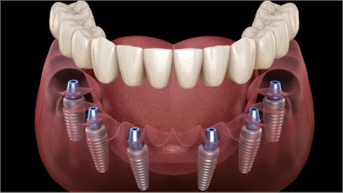 Animated implant denture being placed over six dental implants