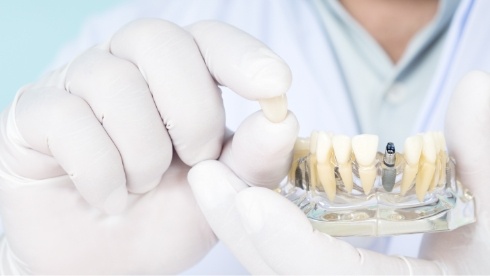 Dentist holding dental crown in one hand and dental implant model in the other