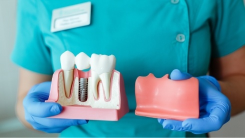 Dentist holding model of gums in one hand and model of dental implant in the other