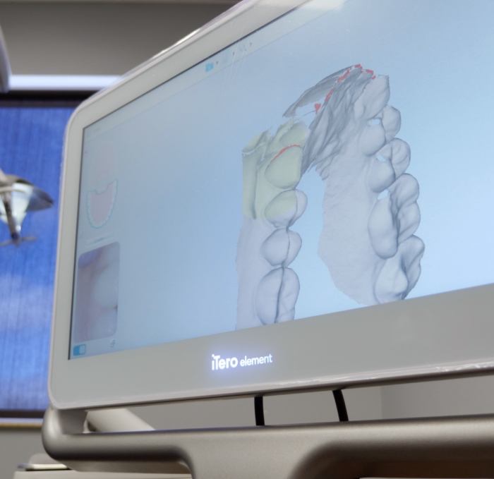 Digital models of a row of teeth on computer monitor
