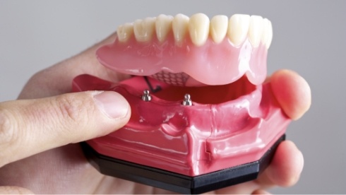 Hand holding a model of an implant denture