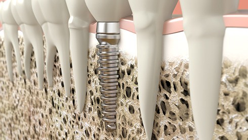 Digital illustration of a dental implant