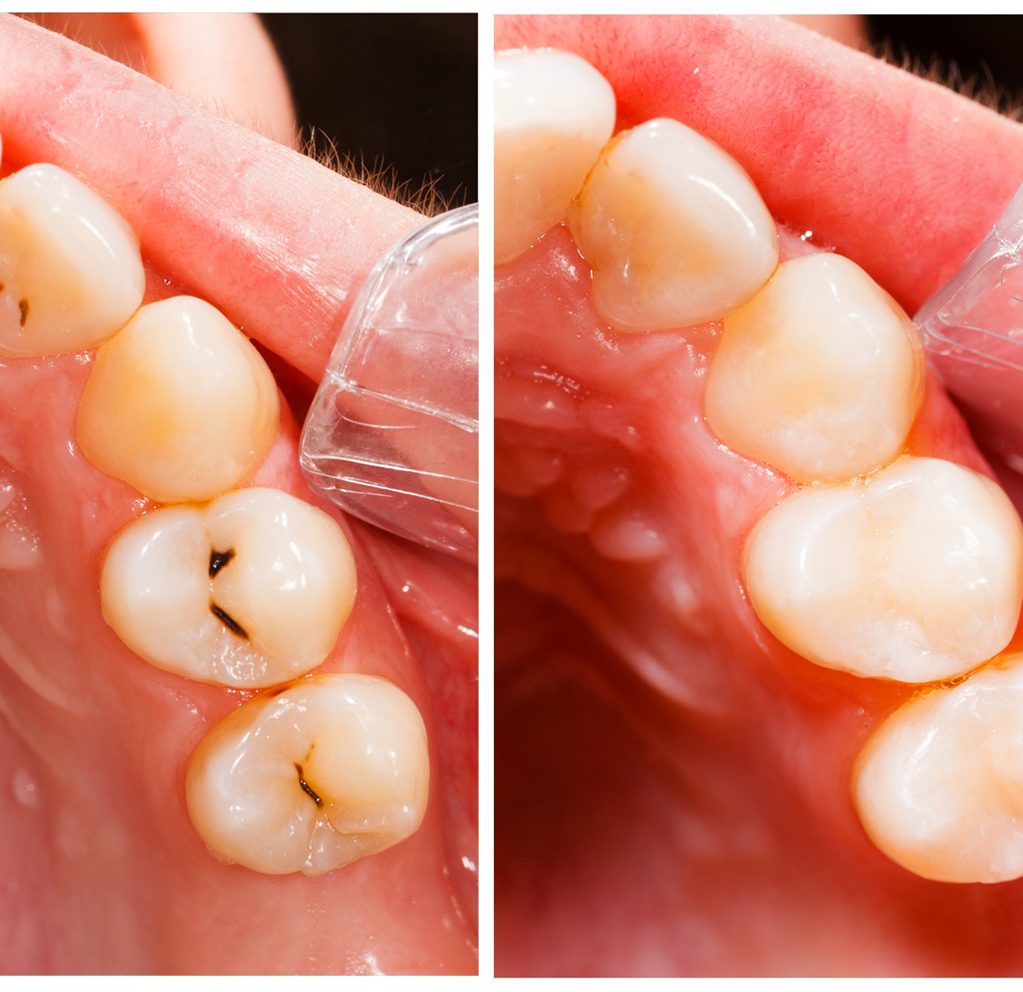 before and after photos of teeth following tooth-colored fillings