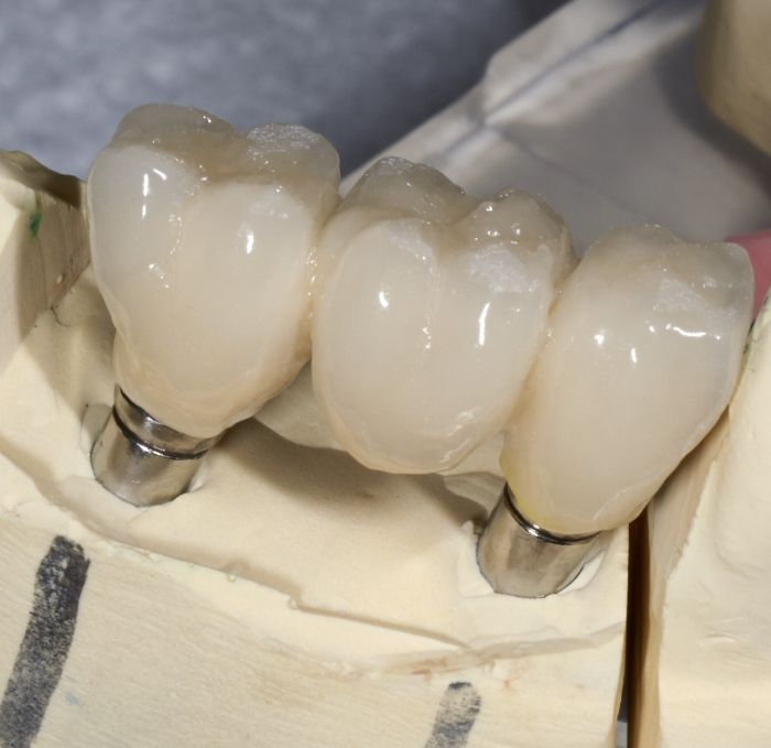 Model of the jaw with a dental implant bridge