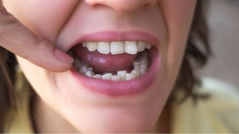 Close up of person pointing to crooked lower teeth