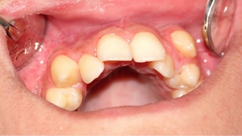 Close up of mouth with row of crowded teeth