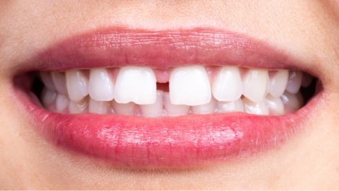 Close up of smile with gap between two front teeth