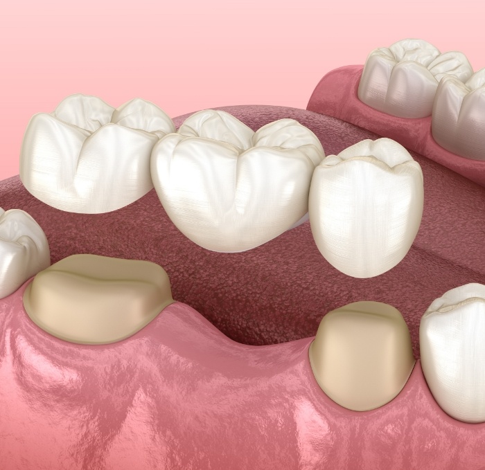 Animated dental bridge replacing a missing tooth in Brandon