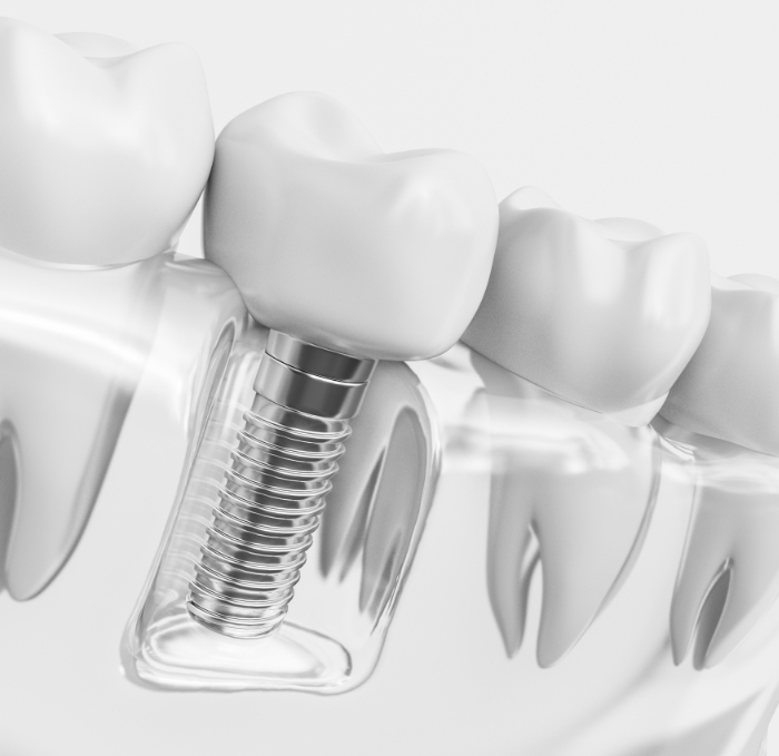 Animated dental implant in the lower jaw