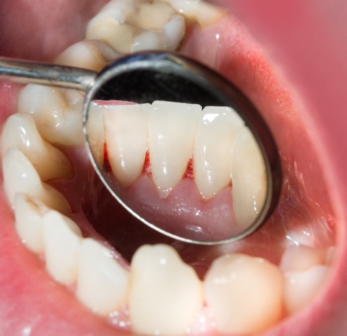 Close up of dental mirror inside of mouth