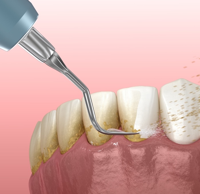 Animated dental tool removing plaque buildup from teeth