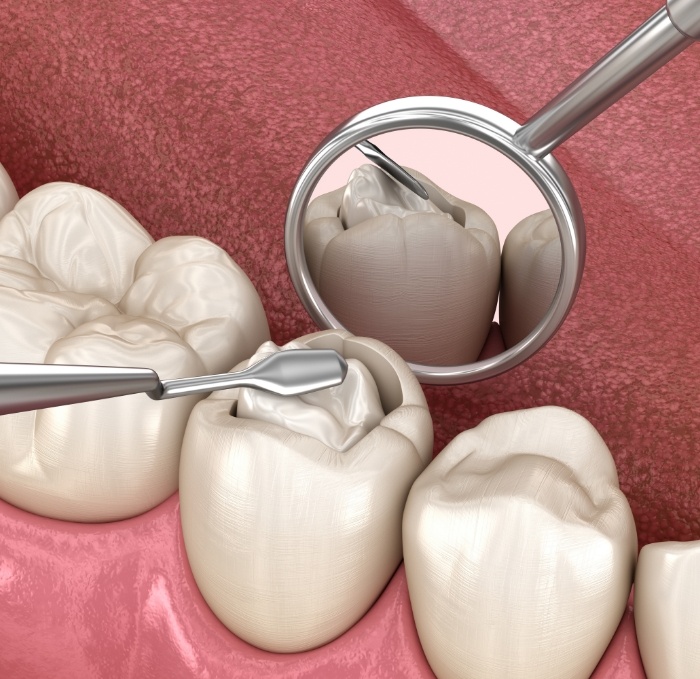 Animated tooth colored filling being placed inside of a tooth