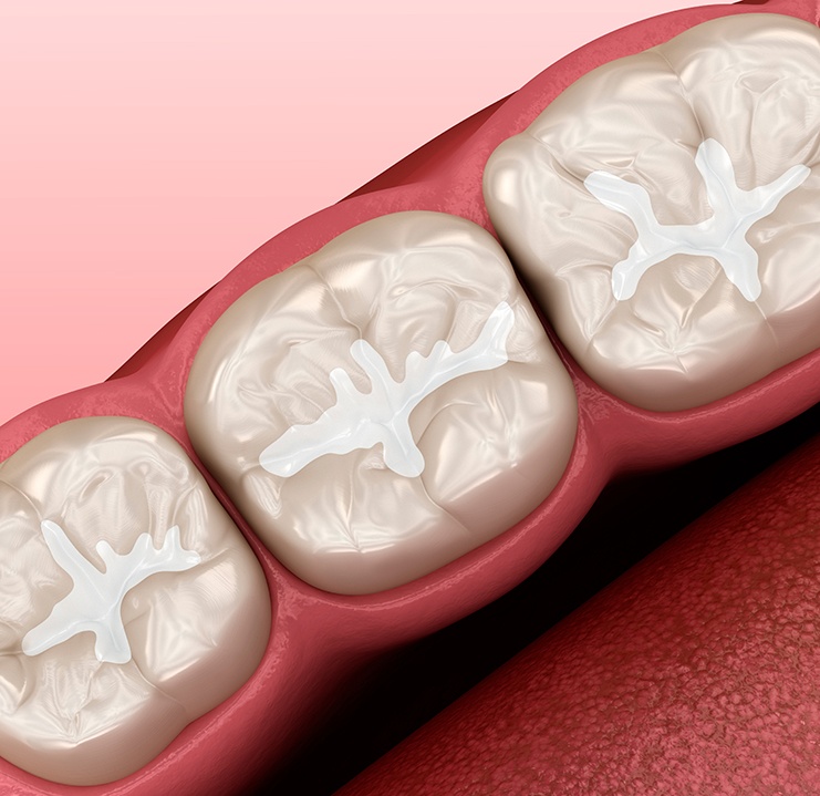 a 3D illustration showing a dental sealant inside the mouth