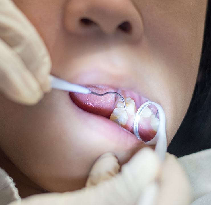 a child receiving a dental sealant