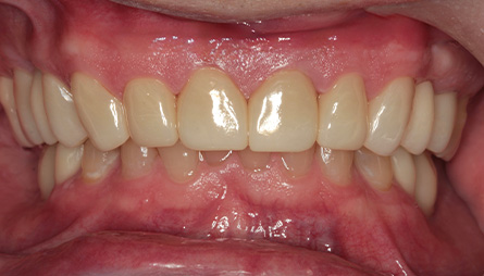 Close up of mouth with evenly spaced front teeth