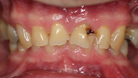Close up of man smiling with evenly spaced front teeth