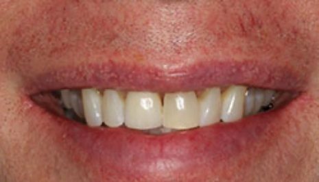 Close up of smile with full row of upper teeth