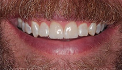 Close up of man smiling with evenly spaced front teeth