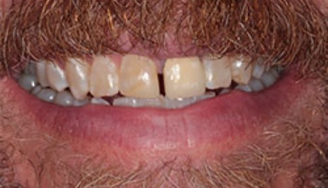 Close up of man smiling with gap between two front teeth