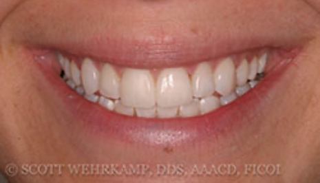 Close up of smile with flawless teeth after cosmetic dental bonding