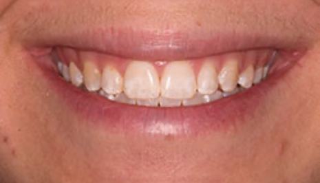 Close up of smile with imperfect teeth before cosmetic dental bonding
