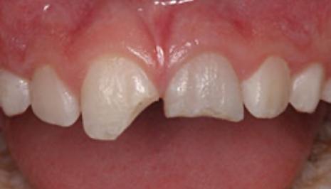 Close up of imperfect teeth