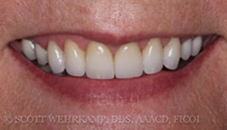 Close up of smile with flawless teeth after cosmetic dentistry
