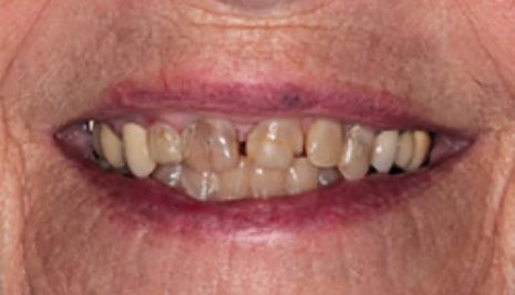 Close up of smile with imperfect teeth before cosmetic dentistry