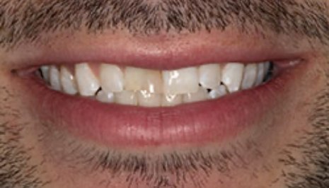 Close up of smile with imperfect teeth