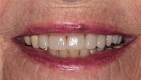 Close up of smile with imperfect teeth