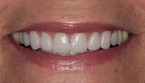 Close up of smile with evenly sized teeth