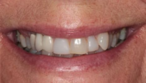 Close up of smile with imperfect teeth