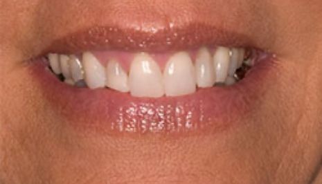Close up of smile with imperfect teeth