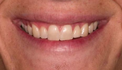 Close up of smile with full set of teeth