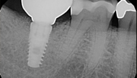 X ray of dental implant in lower jawbone