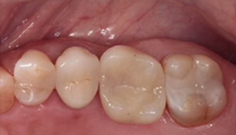 Close up of row of molars