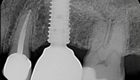 X ray of dental implant in upper jaw