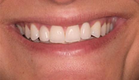 Close up of smile after replacing two missing teeth