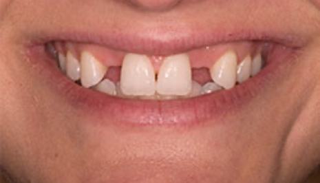 Close up of smile with two missing upper teeth
