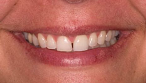 Close up of smile after fixing chipped tooth