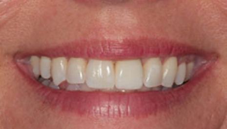 Smile after fixing discolored tooth