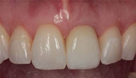 Mouth after fixing discolored tooth