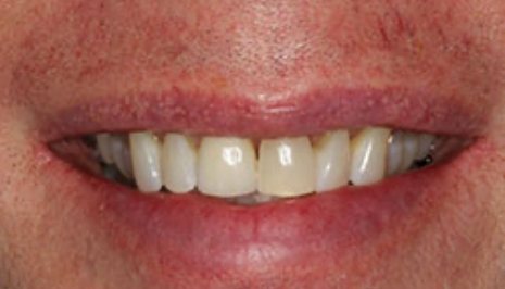 Smile with full row of upper teeth