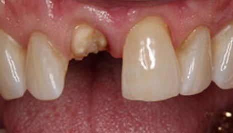 Mouth with upper tooth with barely any enamel left