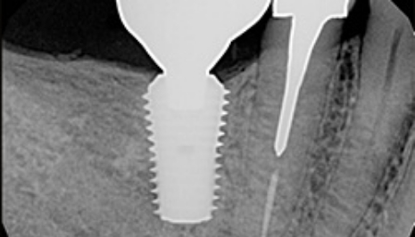 X ray of jawbone with a dental implant